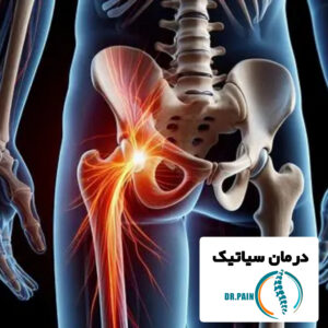 سیاتیک چیست و چه علائمی دارد | درمان سیاتیک برای همیشه