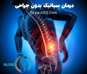 درمان سیاتیک برای همیشه بدون نیاز به جراحی