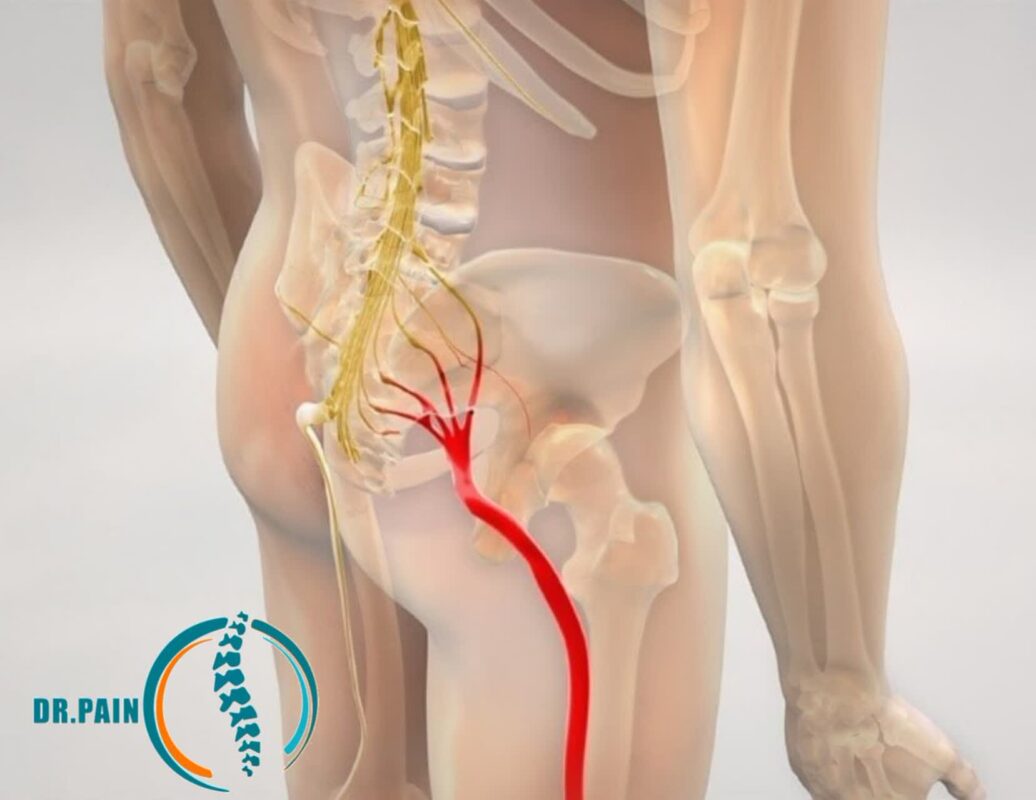 علائم پاره شدن رگ سیاتیک | درمان سیاتیک در تهران