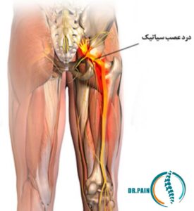 علائم پاره شدن رگ سیاتیک | درمان سیاتیک در تهران