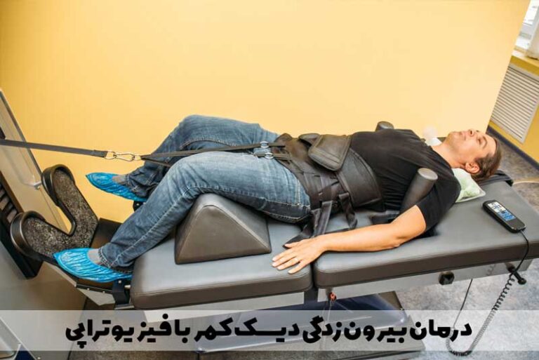 درمان بیرون زدگی دیسک کمر با فیزیوتراپی