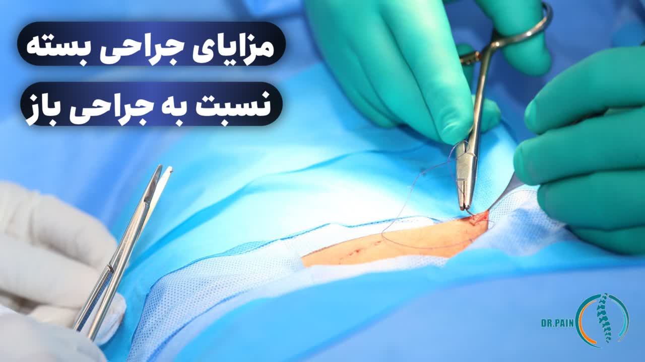 مزایای جراحی بسته نسبت به جراحی باز کمر